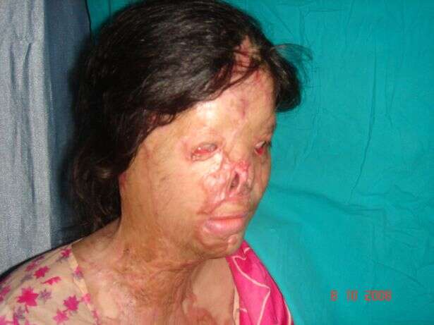 לפני הניתוח בפנים 